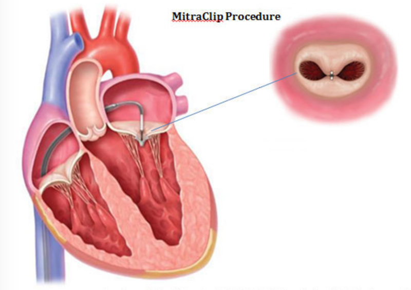 Ayurvedic Treatment For Leaking of Heart Valves